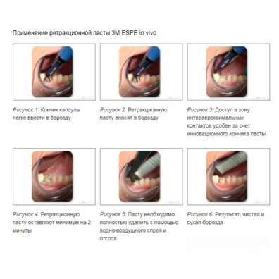 Ретракційна паста, 3M ESPE, Astringent Retraction Paste, капсула 0.3 г